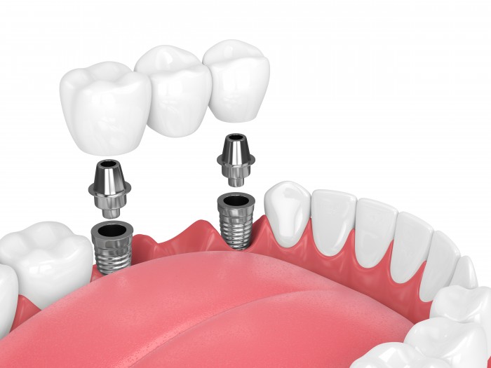 Untertitel: Zahnbrücke getragen auf zwei Implantaten