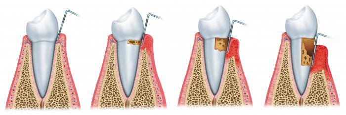 Die verschiedenen Stadien der Parodontitis