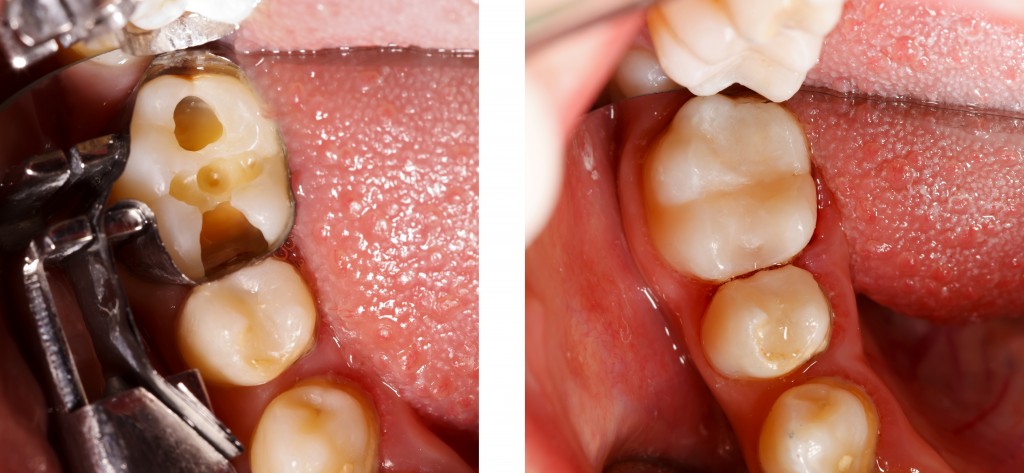 Die richtige Füllung bei einem Loch im Zahn - 360°zahn