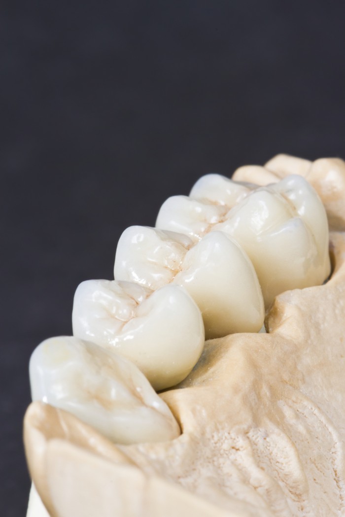 Keramikbrücken werden sehr häufig für die Versorgung einer Zahnlücke verwendet