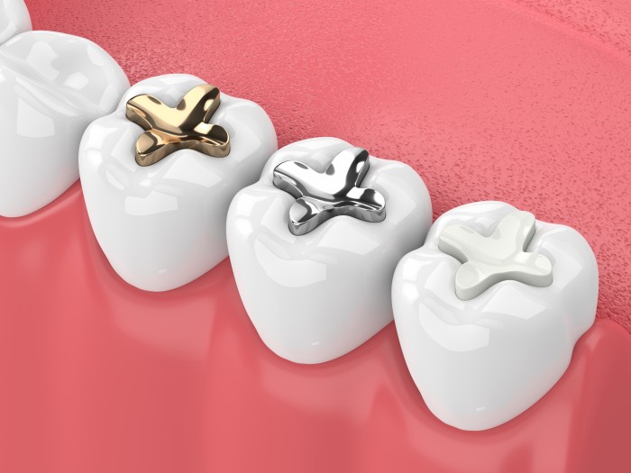 Keramik, Gold, Kunststoff oder Metall - das verwendete Material für die Zahnfüllung beeinflusst den Preis