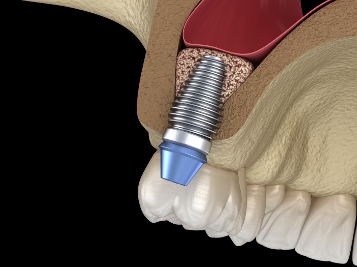 Knochenaufbau vor Zahnimplantat