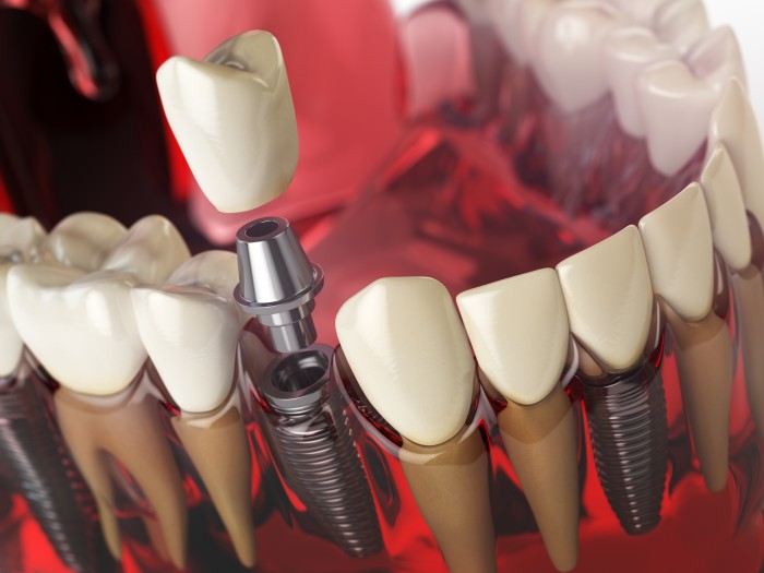 Ein Zahnimplantat wird fest im Kieferknochen verankert und gilt als optimaler Zahnersatz