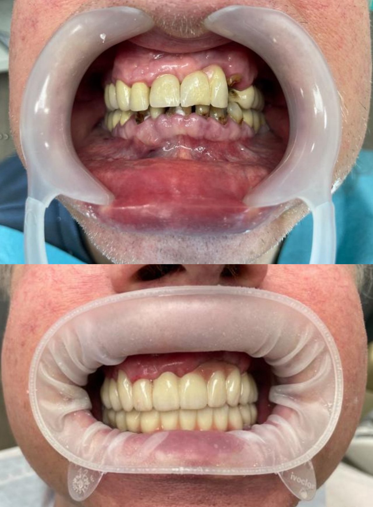 Brücke auf 4 Implantate_ Ober- und Unterkiefer