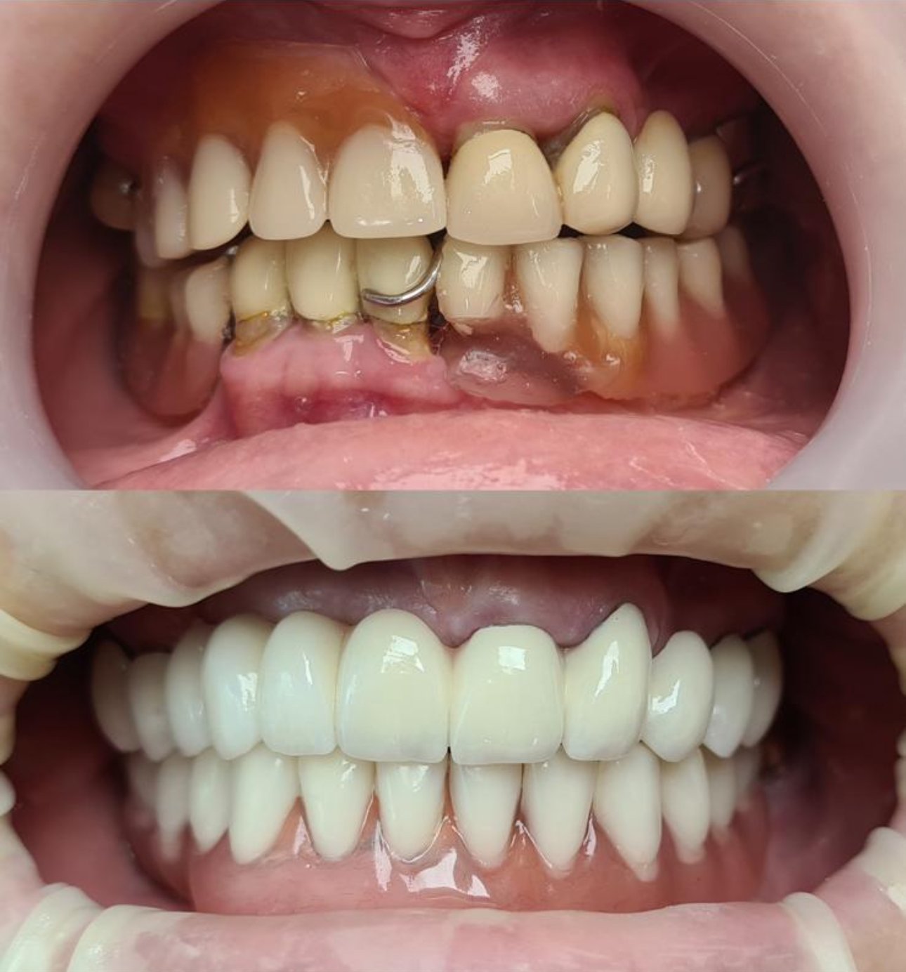 Brücke auf Implantate und auf eigenen Zähne