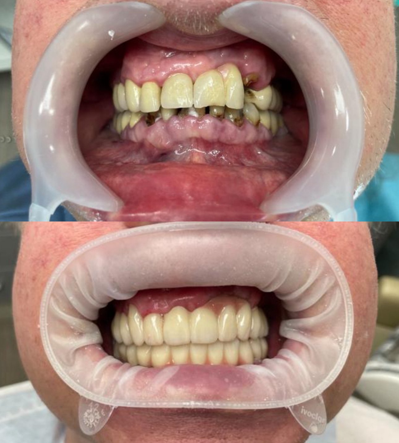 Brücke auf Implantate_ Ober- und Unterkiefer