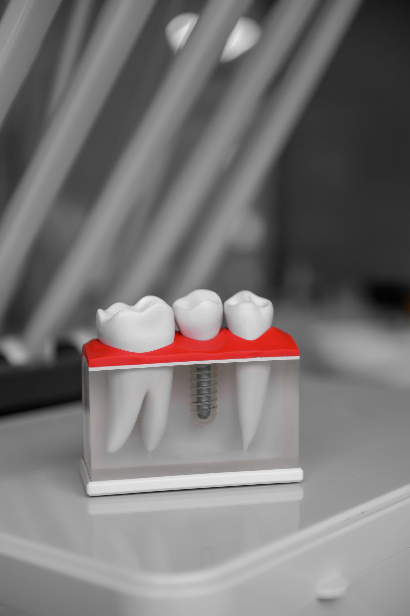 3D-Modell eines Oberkiefers mit Zahnimplantat und aufgesetzter Krone — Veranschaulichung der Implantatversorgung