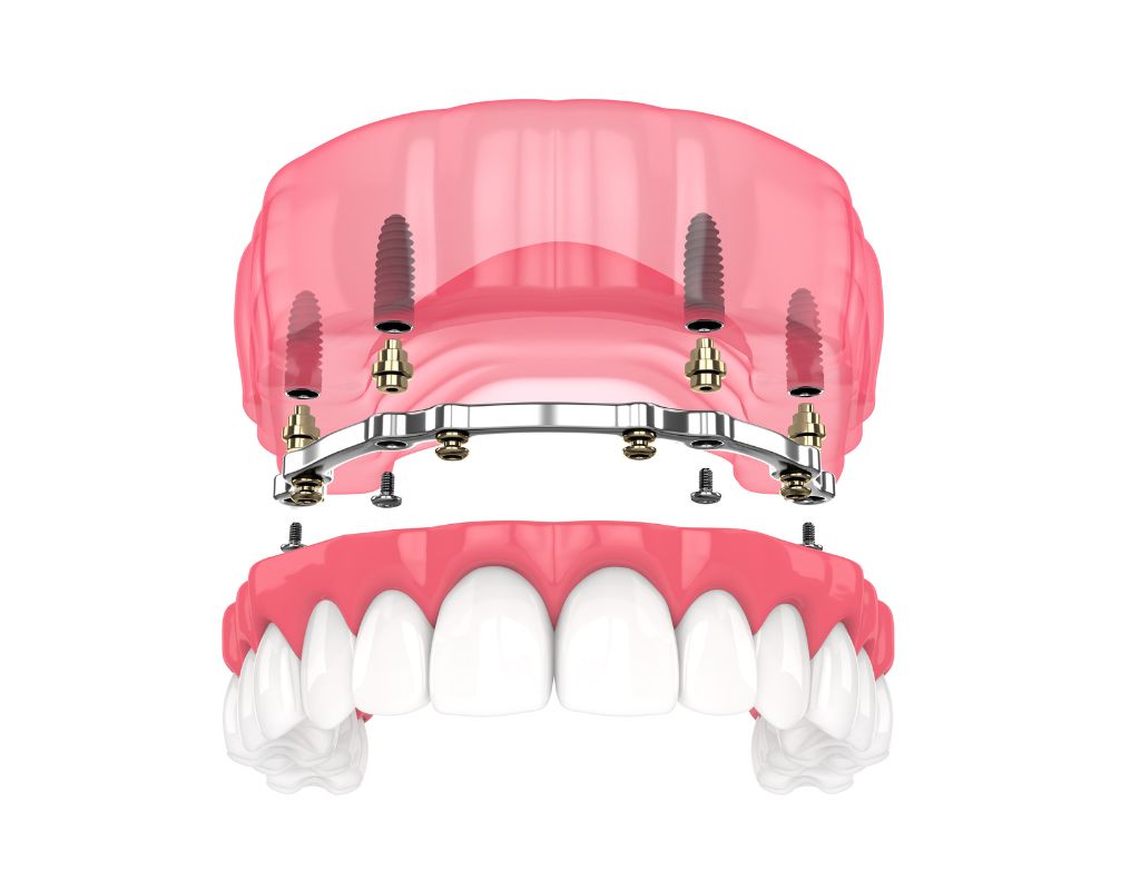 Beispiel einer Lokator-Prothese auf Implantaten — Versorgung im CompletDent Meisterlabor