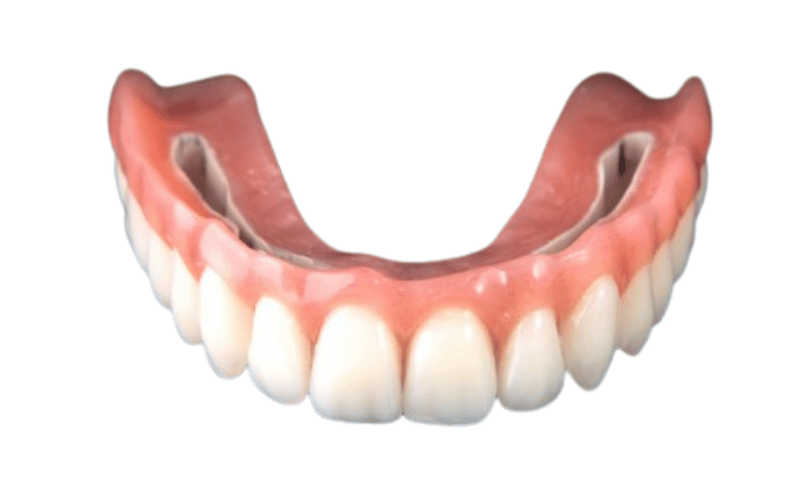 Stegprothese auf Implantaten — feste und herausnehmbare Versorgung bei CompletDent