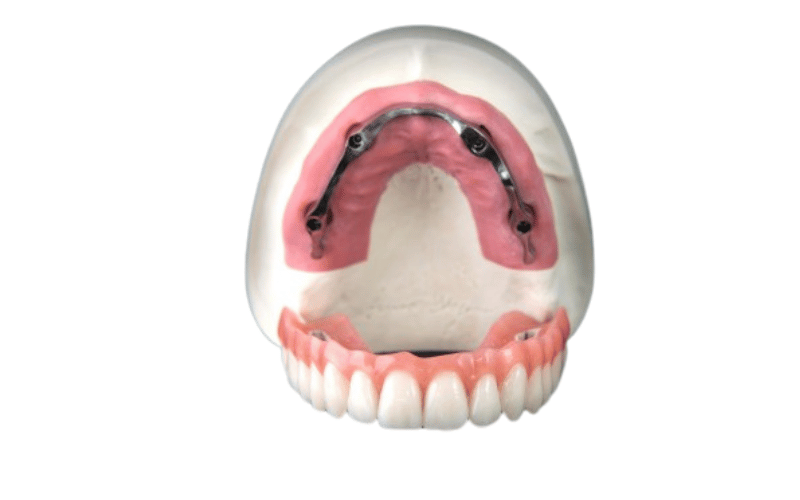 Stegprothese auf Implantaten — feste und herausnehmbare Versorgung bei CompletDent