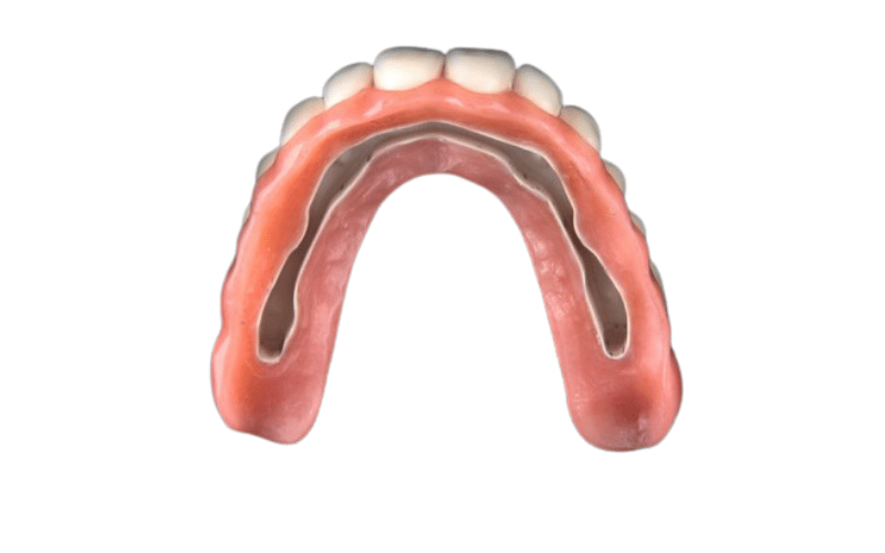 Stegprothese auf Implantaten — feste und herausnehmbare Versorgung bei CompletDent