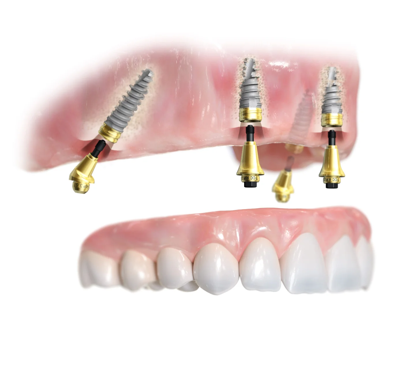 Nobel Biocare Logo — Premium-Implantatsystem im Einsatz bei CompletDent